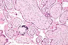 Micrograph of a placental infection (CMV placentitis)