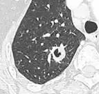 Cavitation with relatively thick wall, in this case aspergilloma).