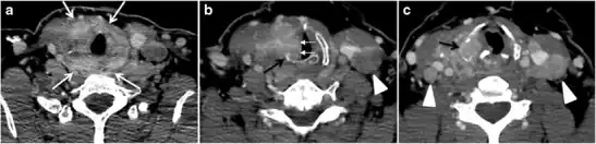 Fig. 6. A 61-year-old female patient with locally aggressive PTC. an Enhanced axial CT scan of the neck demonstrates a heterogeneous infiltrative thyroid mass. This mass diffusely involves the entire gland and circumferentially encases the trachea with involvement of bilateral tracheoesophageal grooves (white arrows). b, c Additional axial cranial images show right cricoid cartilage destruction (black arrows in b), right thyroid cartilage destruction (black arrow in c), right vocal cord paralysis (white arrows in b), and bilateral cervical lymphadenopathy (arrowheads).
