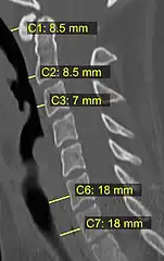 CT scan with upper limits of the thickness of the prevertebral space at different levels.