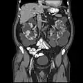 Abdominal CT scan of an adult with autosomal dominant polycystic kidney disease: Extensive cyst formation is seen over both kidneys, with a few cysts in the liver, as well. (Coronal plane)