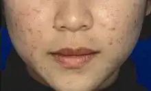 Acne ridden face