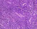 Anaplastic (microcellular, oat cell) carcinoma from the lung (histopathology)