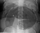 Plain X ray of a cecal volvulus