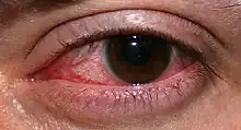 Closeup of an eye infection after wearing contact lenses