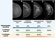 Mammograms of 4 different breasts of increasing density levels: predominantly fatty, scattered fibroglandular, heterogeneously dense, and extremely dense.