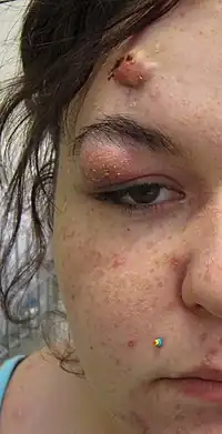 A photograph of a human face with nodular acne