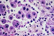 Cytomegalovirus infection - Case 301