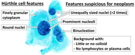 Cytopathology suspicious for Hürthle cell neoplasm (Bethesda category IV, rather than Hürthle cell hyperplasia), Pap stain.