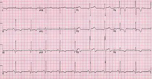 ECG showing HOCM