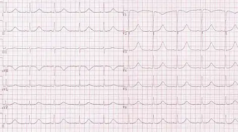 Long QT syndrome