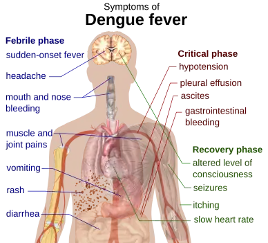 Outline of a human torso with arrows indicating the organs affected in the various stages of dengue fever