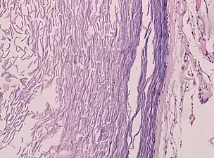 Histopathology showing epithelium and lamellated keratin (left)