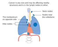 Stage IIIB lung cancer