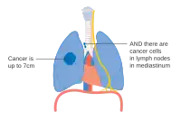 Stage IIIA lung cancer