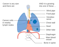 Stage IIIA lung cancer
