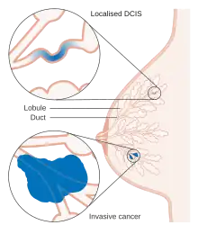 Diagram showing ductal carcinoma in situ (DCIS)