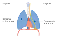 Stage IA and IB lung cancer