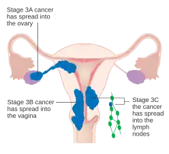A diagram of stage III endometrial cancer