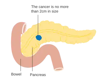 Stage T1 pancreatic cancer