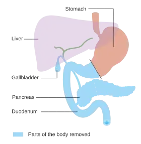 Diagram of the alimentary tract highlighting the gallbladder, pancreas, duodenum and distal stomach