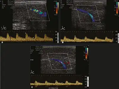Longitudinal, ventral ultrasound of the penis, with pulsed mode and color Doppler. Flow of the cavernous arteries at 5, 15, and 25 min after prostaglandin injection (A, B, and C, respectively). The cavernous artery flow remains below the expected levels (at least 25–35&nbsp;cm/s), which indicates ED due to arterial insufficiency.