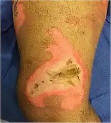 An image of a skin burn to the medial right thigh above the knee of a 35-year-old male.