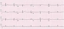 An ECG showing sinus bradycardia at 43 bpm. The image is made up of a red grid on a white background. A black line traces the patients heart beat.