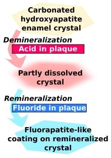 Carbonated hydroxyapatite enamel crystal is demineralised by acid in plaque and becomes partly dissolved crystal. This in turn is remineralised by fluoride in plaque to become a fluorapatite-like coating on remineralised crystal.