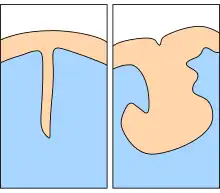 Cross-section of desirable outcome shows a narrow, smooth incision. Undesirable outcome shows a widened incision with an irregular surface.