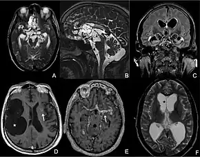  MRI of extraparenchymal neurocysticercosis