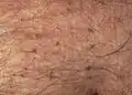 Pubic lice on the abdomen