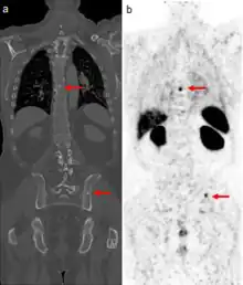 Medical images of a man's torso. Arrows indicate tumor metastases, visible as dots in the man's spine and pelvis, in both scans.