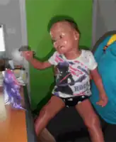 Harlequin ichthyosis in a 3-year-old girl, the keratin scales having almost completely fallen off