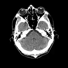 An slice through the head, showing the cerebellum, a small portion of each temporal lobe, the ears, the orbits, and the sinuses. Bone appears white on the black background; brain, eyeballs and ears are grey.