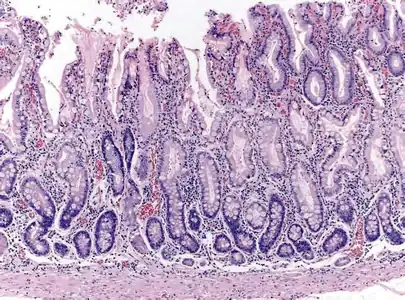 Histopathology of antral mucosa with atrophy. H&E 10x. Antral gastric mucosa with accentuated atrophy because of replacement by extensive intestinal metaplasia.