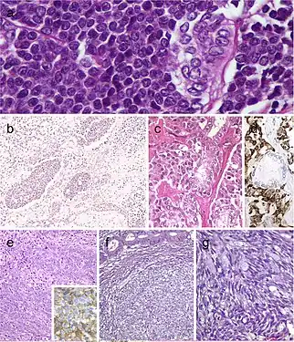 Carcinoma of the thyroid with Ewing family tumor elements (CEFTE) disclosing solid nests of small cells with regular, round nuclei, and nests of papillary thyroid carcinoma (PTC) (a). This case is from a 17-year-old female patient with bilateral involvement of the thyroid by a malignant thyroid teratoma (b); the tumor discloses nests of small cells, rich stroma with chondroid appearance and an epithelial-tubular component. Mixed medullary and papillary thyroid carcinoma (c); the medullary thyroid carcinoma component stained positively for calcitonin mRNA while the PTC (follicular variant) component was negative (d). Intrathyroid thymic carcinoma (ITC) also known by the acronym (CASTLE) showing positivity for CD5 (inset) (e). Spindle epithelial tumor with thymus-like differentiation (SETTLE) is a lobulated tumor composed of spindle cells and epithelioid cell component with glands, mucinous cysts, and/or squamous nests (f and g)
