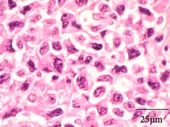 Extranodal NK/T cell lymphoma, nasal type. It may be incidentally discovered in people undergoing surgery for sinusitis.