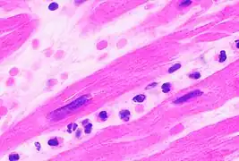 Neutrophils are seen in a myocardial infarction at approximately 12–24 hours, as seen in this micrograph.
