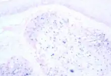 Image of human papillomavirus-associated oropharyngeal cancer, under a microscope. The tissue has been stained to show the presence of the virus by in situ hybridisation