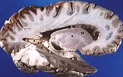 Human brain right dissected lateral view