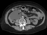 Massive hydronephrosis as marked by the arrow