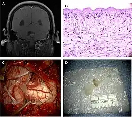  Imaging, pathology, and surgical findings of neurocysticercosis