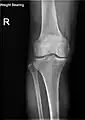 Knee X-ray (weight bearing)
