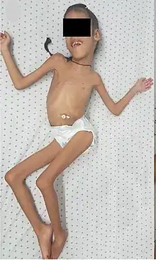 Lama2-congenital-muscular-dystrophy-deformities