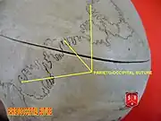 Lambdoid suture with Wormian bones, seen from behind.