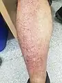 Lichen amyloidosis on a 56-year-old male's leg