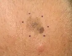 Melanoma, vertex scalp marked for biopsy