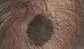 Melanoma, mid frontal scalp