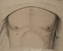 Drawing of a man with supernumerary nipples
